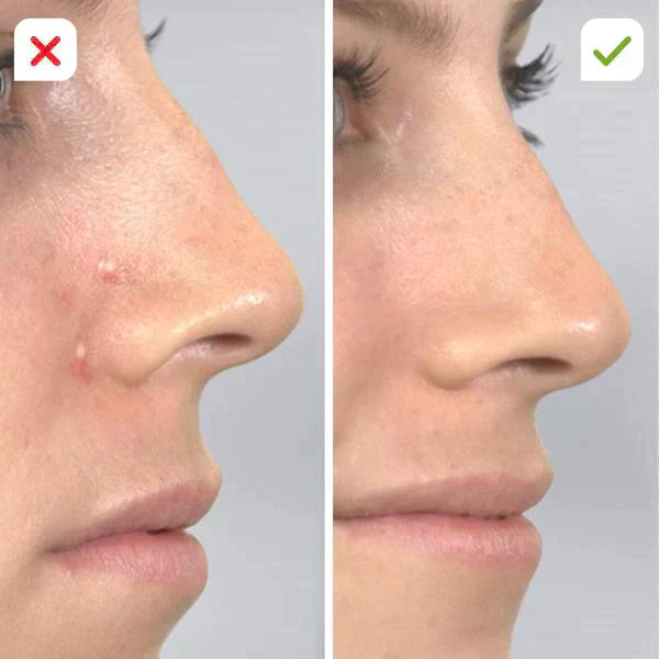 DERMASUCTION™ | PIMPLE & BLACKHEAD REMOVER